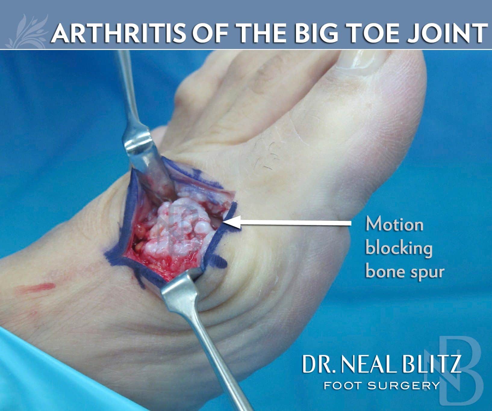 Big Toe Arthritis Surgery  Learn about Symptoms &  Treatment