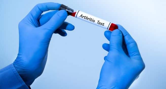 Blood tests for arthritis  what you need to know