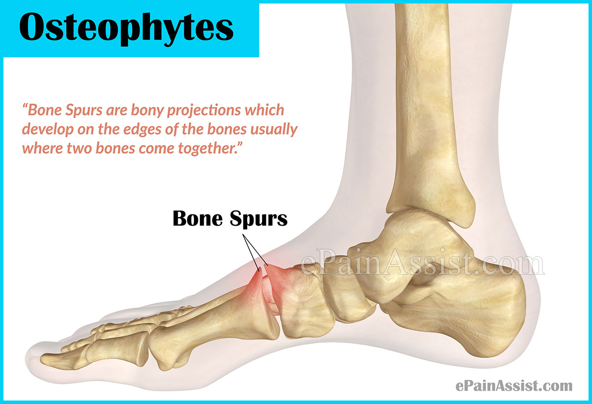 Bone Spurs or Osteophytes: Treatment, Causes, Symptoms