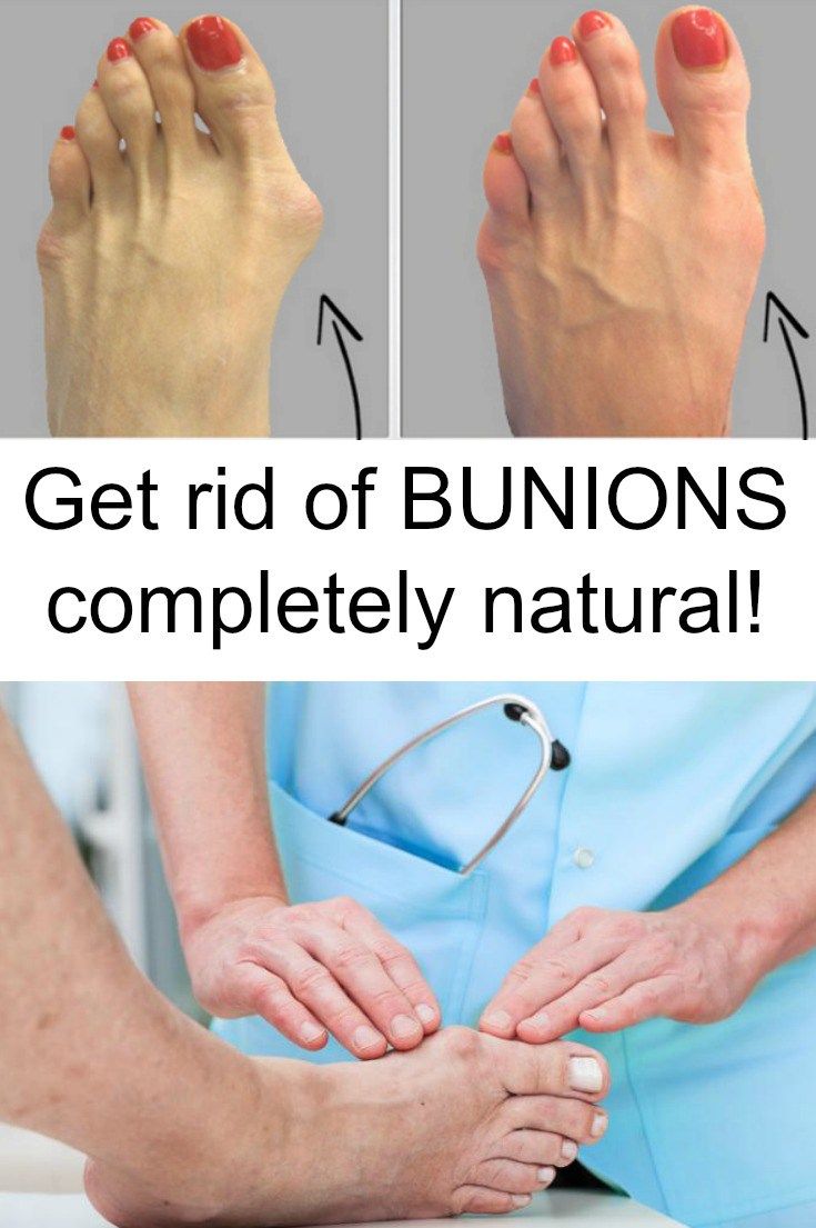 Bunions cured with this completely natural remedy!