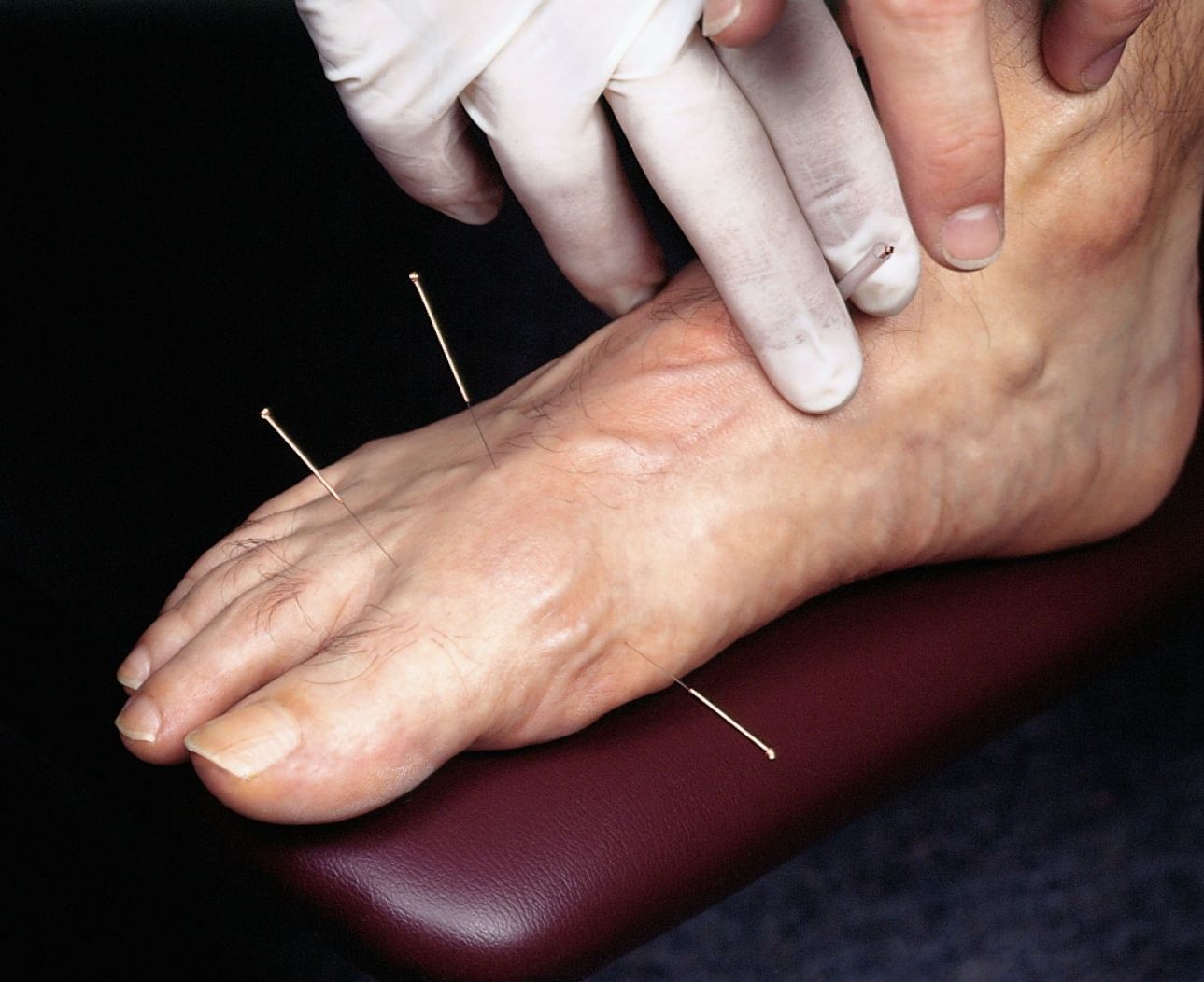 Can Acupuncture Help Arthritis (Dengan gambar)