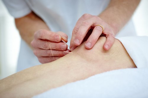 Can Acupuncture Help Arthritis Pain?