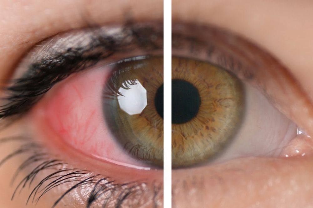 Can Arthritis Affect Your Eyes?