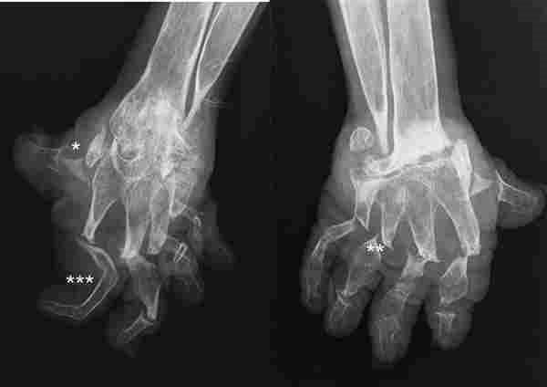 Can Arthritis Show Up On An X Ray Psoriatic Finger ...