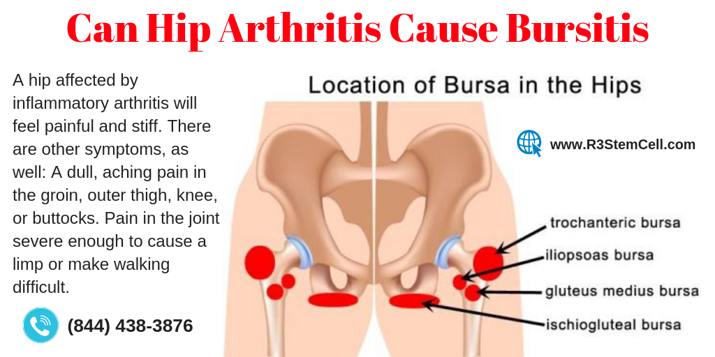 Can Hip Arthritis Cause Bursitis? A hip affected by ...