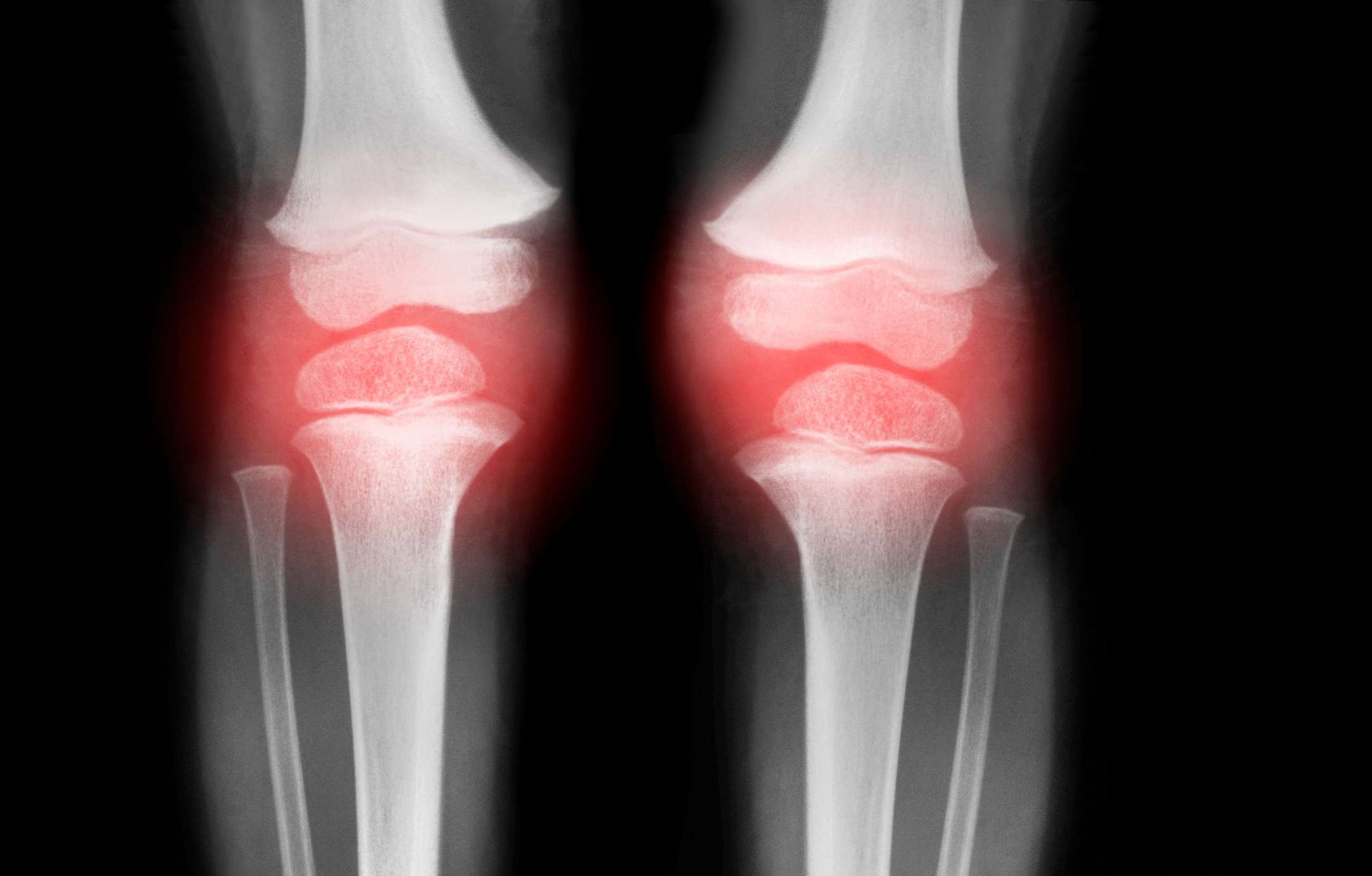 Can Osteoarthritis Be Reversed?