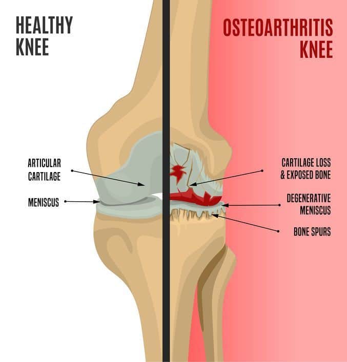 Can Osteoarthritis Of The Knee Cause Leg Pain