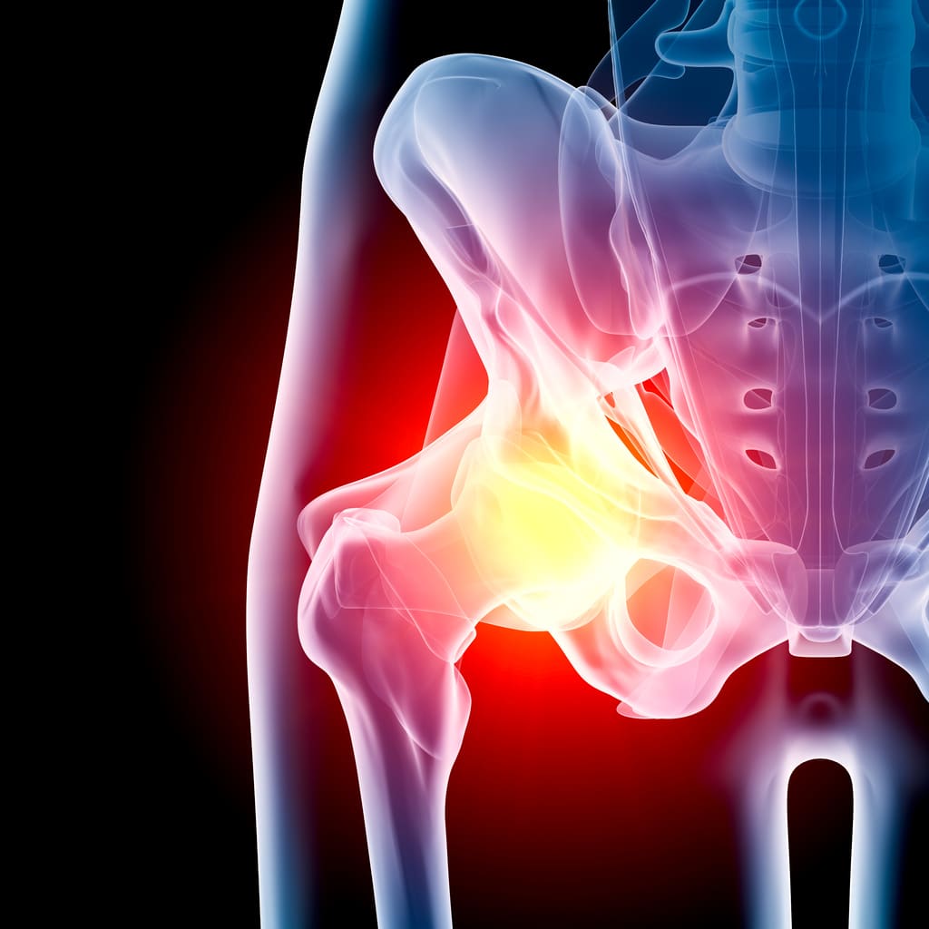 Can Physical Therapy Help with My Hip Arthritis?