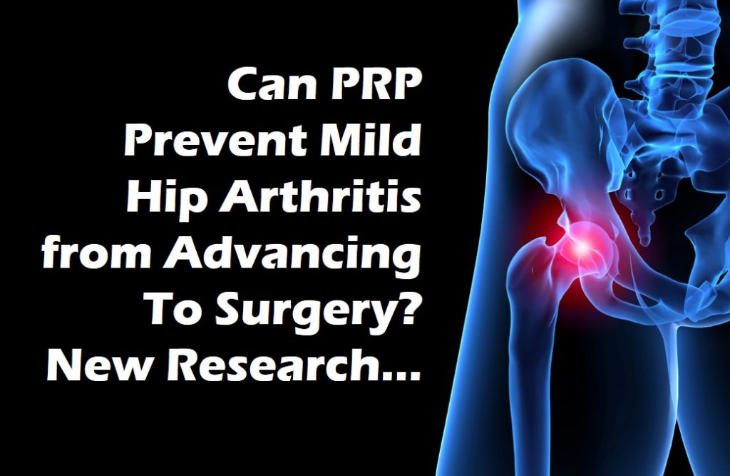 can prp help early hip arthritis patients avoid surgery