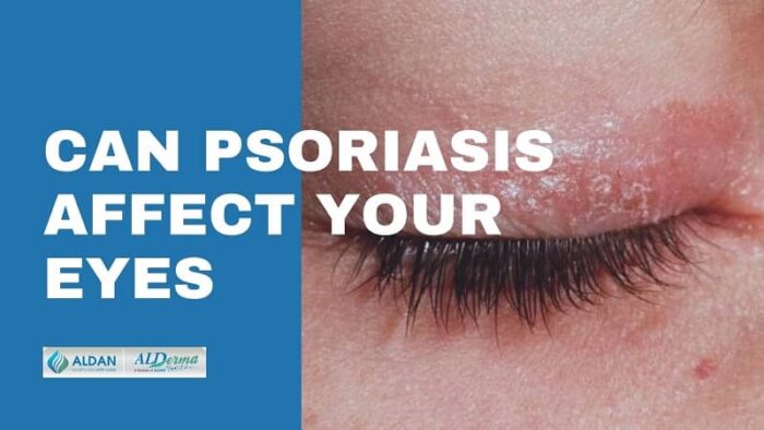 Can Psoriasis Affect Your Eyes [Psoriatic Arthritis Eye ...