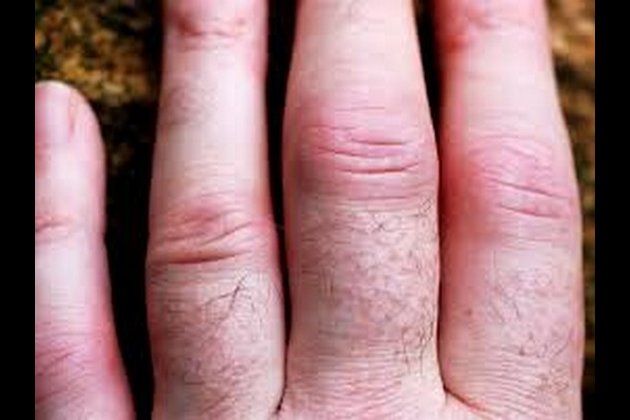 Can rheumatoid arthritis be delayed or prevented?