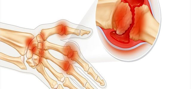 Can Rheumatoid Arthritis Go Away On Its Own
