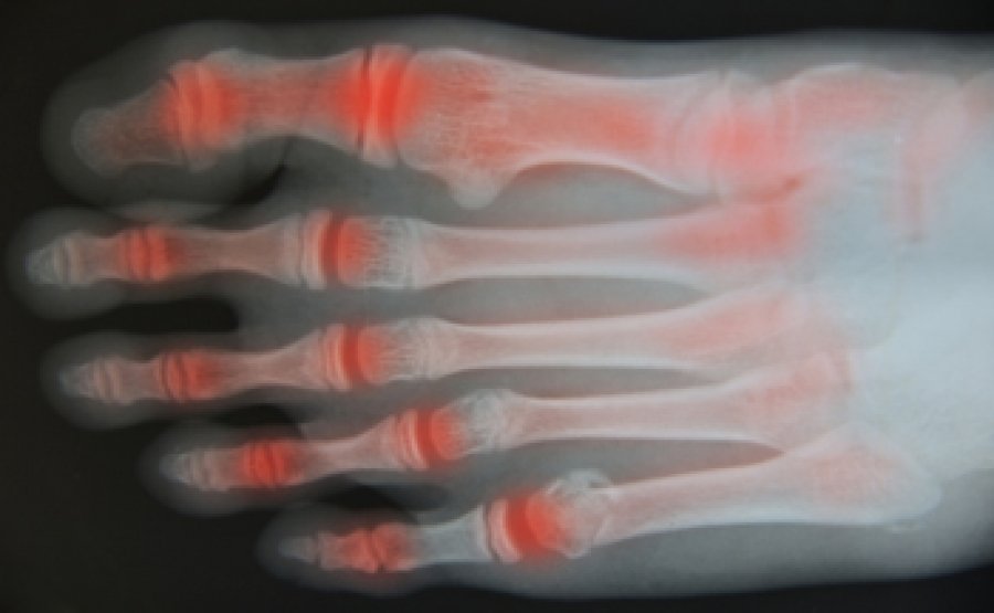 Can Rheumatoid Arthritis Occur in Feet?