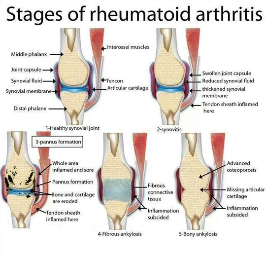 Can rheumatoid arthritis strike at any age?