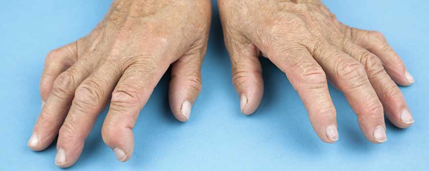 Caring for patients with rheumatoid arthritis in the community ...