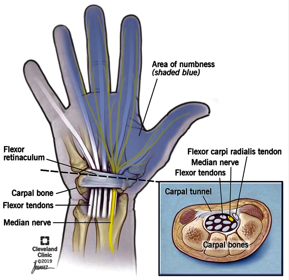 Carpal tunnel syndrome: The invisible threat