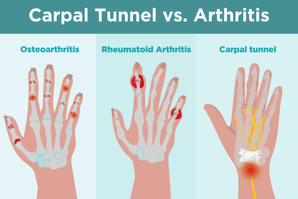 Carpal Tunnel Syndrome vs. Arthritis: Whats the Difference?