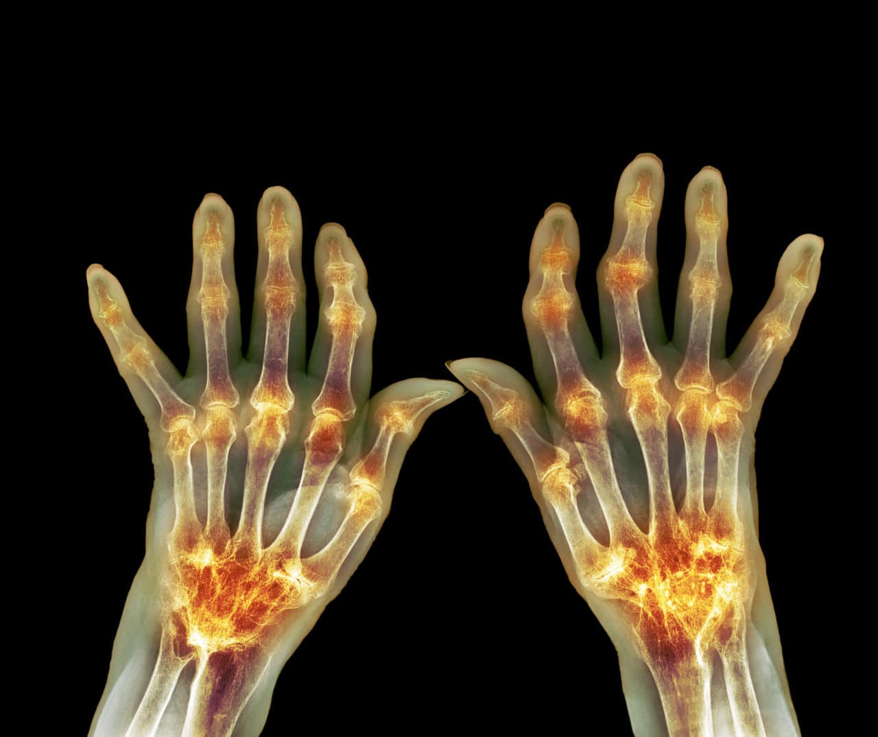 Case Study: Cardiac Manifestations of Rheumatoid Arthritis