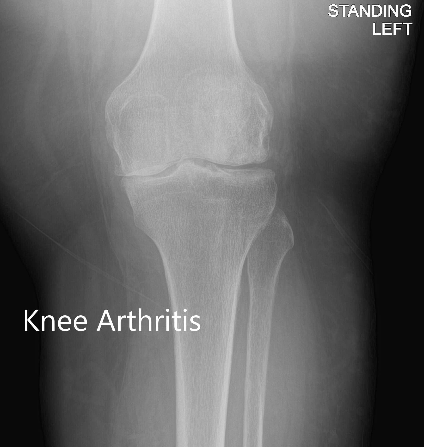 Case Study Osteoarthritis With A Total Knee