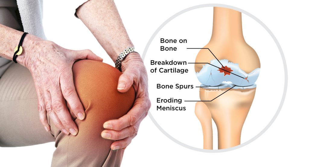 Causes, Symptoms and Treatment of Osteoarthritis