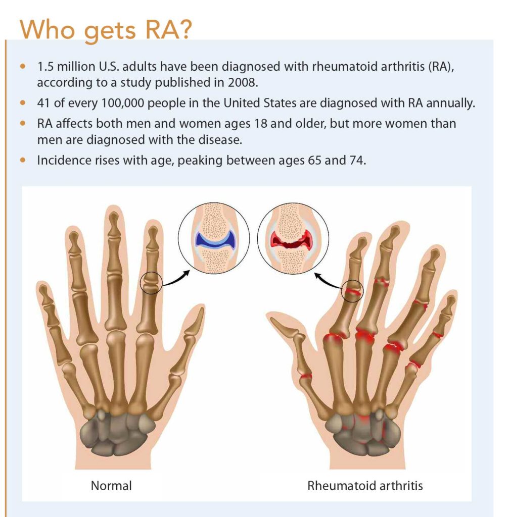 CBD For Rheumatoid Arthritis â What You Should Know