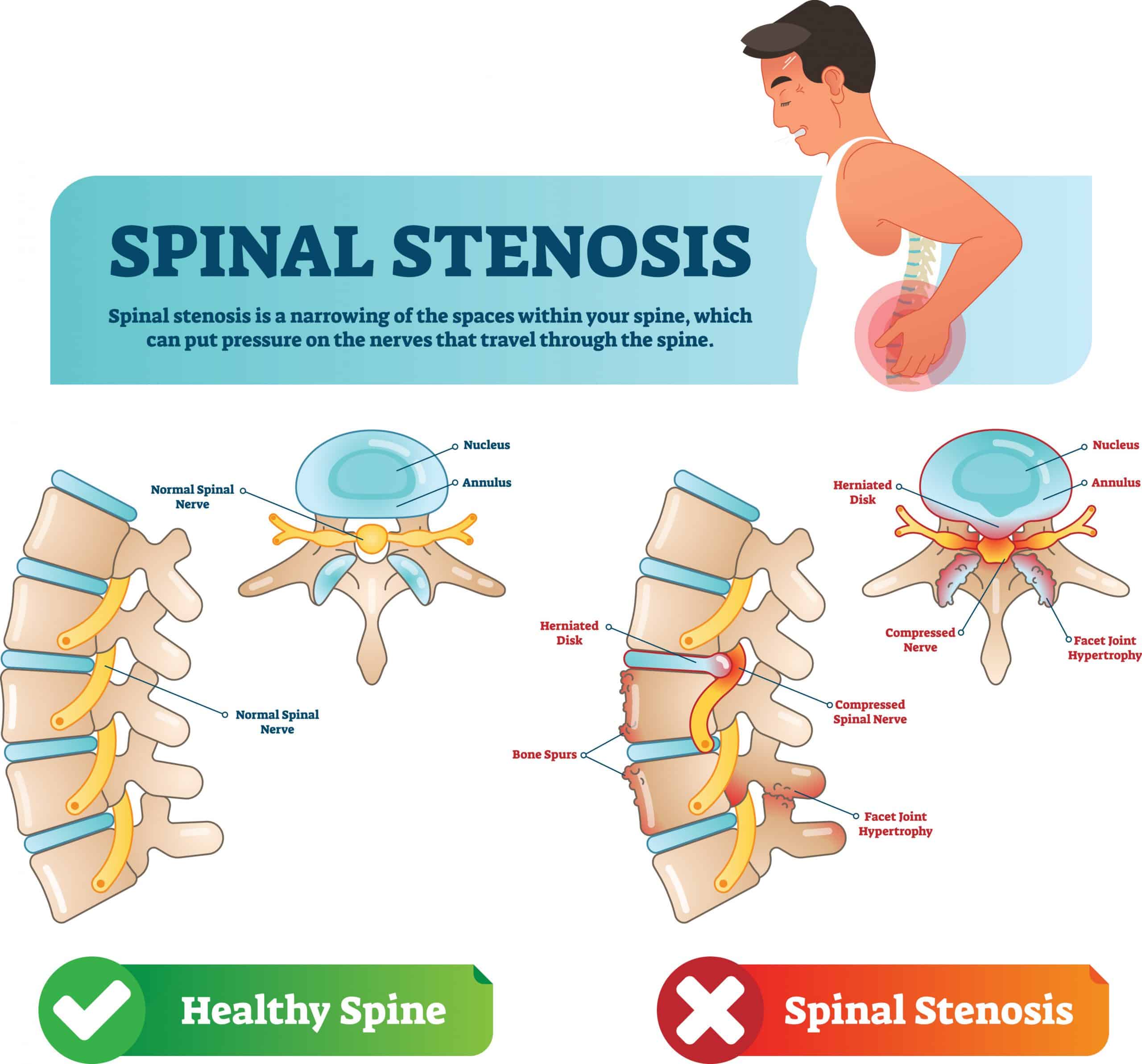 Chiropractic Care for Spinal Stenosis Pain