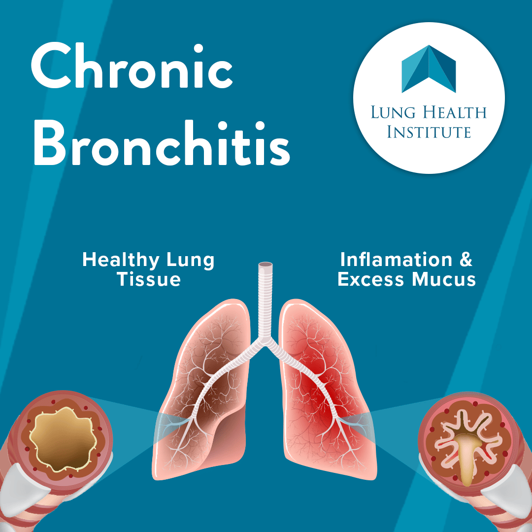 Chronic bronchitis is a progressive lung disease that affects the ...