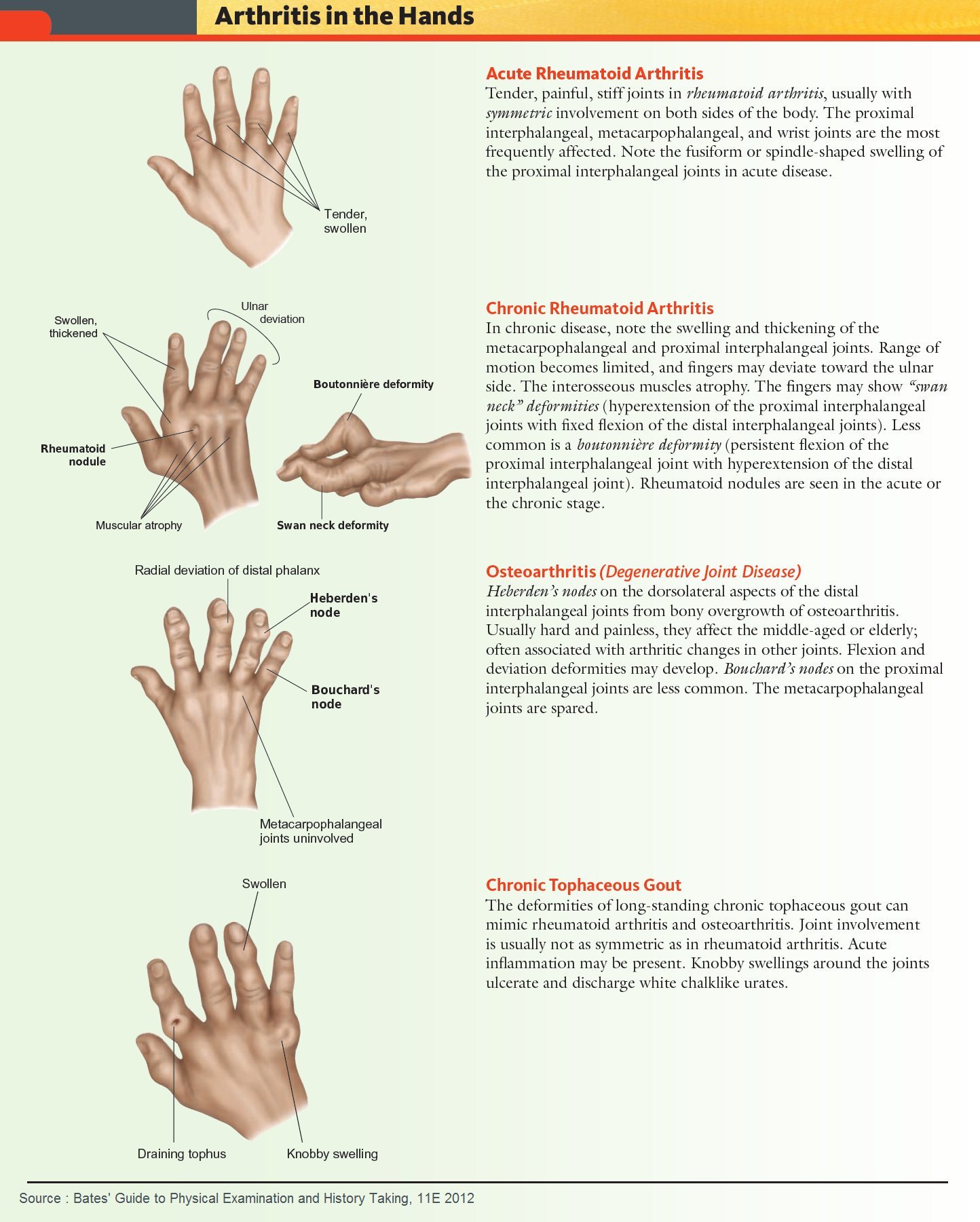 Common Forms of Arthritis in the Hands Acute Rheumatoid ...