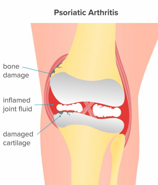 Common Types Of Arthritis That Affect The Knee â cyriaxphysio