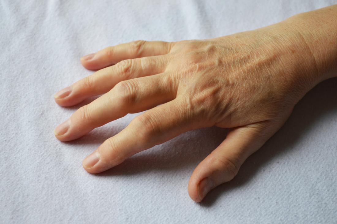 Como você administra a artrite nas mãos?