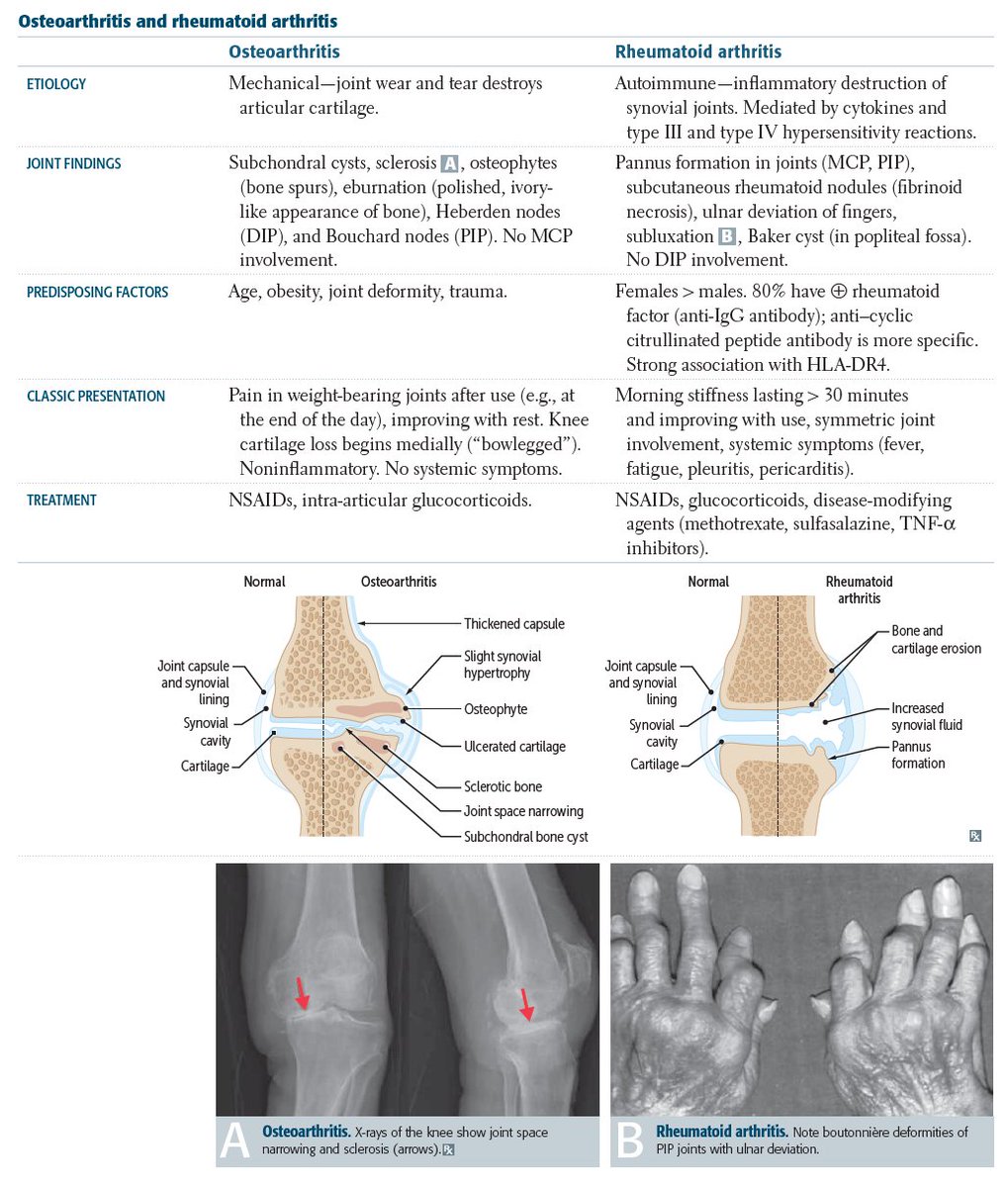 Comparing Osteoarthritis and Rheumatoid Arthritis #Osteoarthritis ...