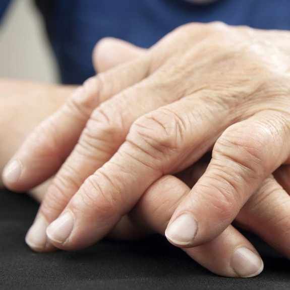 Complications of Rheumatoid Arthritis