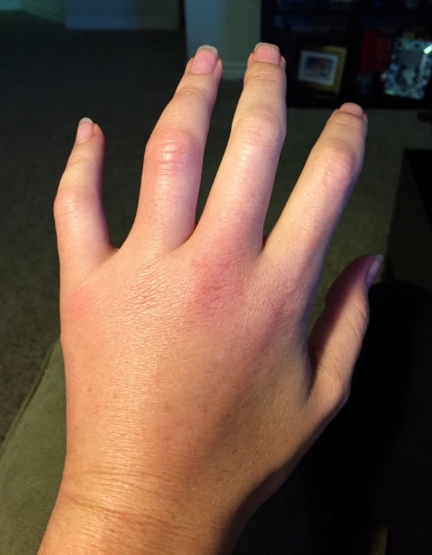 Could this be psoriatic arthritis?