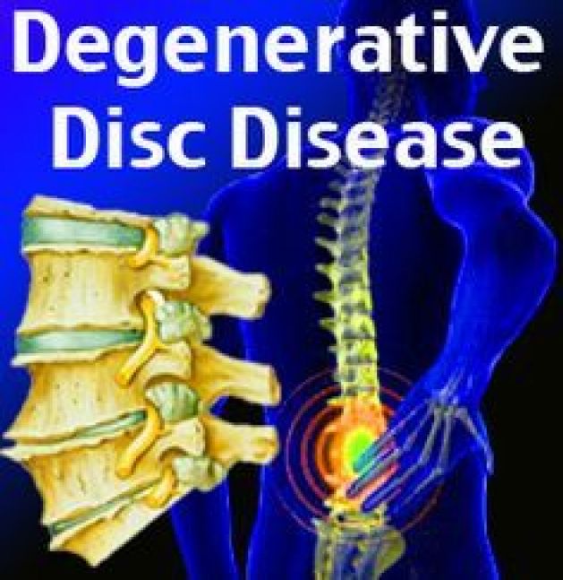 Degenerative Disc Disease Symptoms. #DrJeff #BackPainBlog #Backpain ...