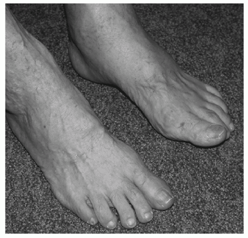 Degenerative Joint Disease of The Midfoot and Forefoot ...