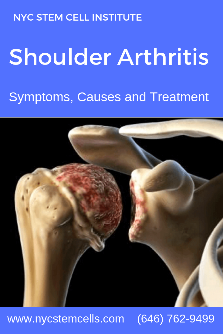 designfurndeals: What To Do For Arthritis In Shoulder