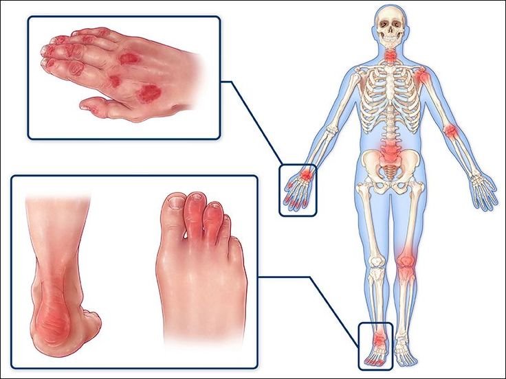 Did you know these Psoriatic Arthritis Flare
