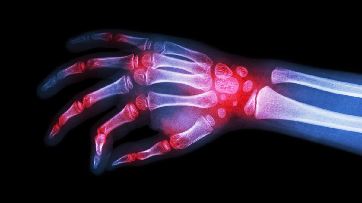 Difference between rheumatoid arthritis and GOUT: