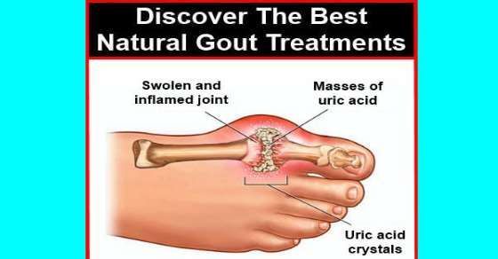 Discover The Best Natural Gout Treatments