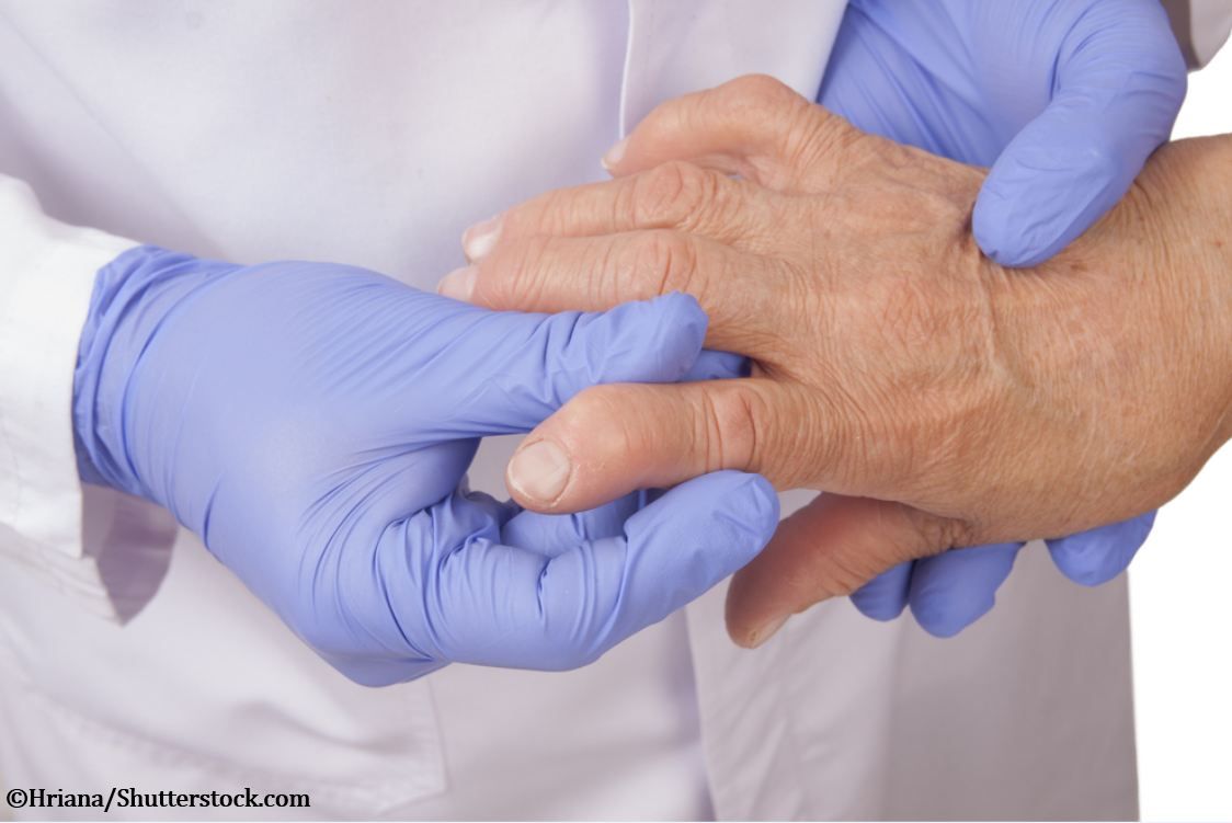 Do You Bruise Easily With Rheumatoid Arthritis