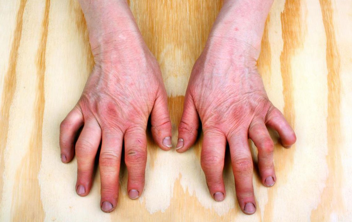 Do you have psoriatic arthritis symptoms » blog.jennystores.com
