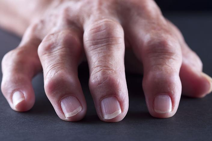 Doctors Explain All the Reasons You May Be Dealing With Swollen Fingers