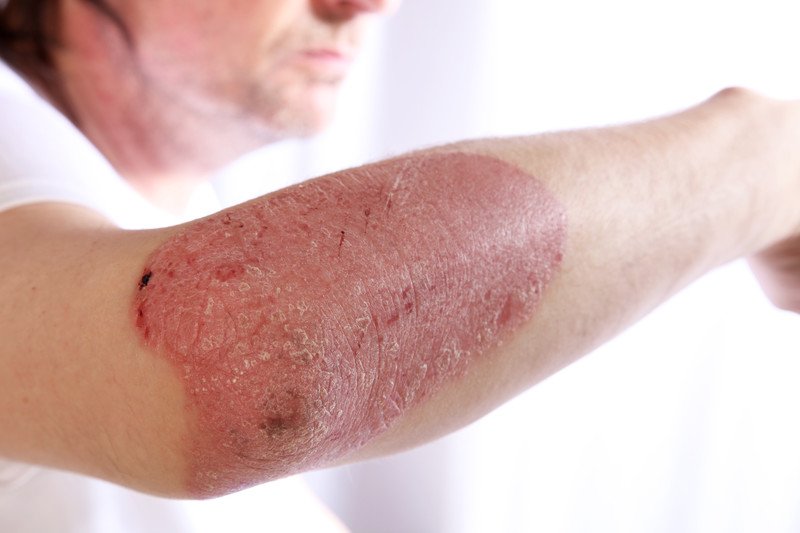Does psoriasis go away on its own?
