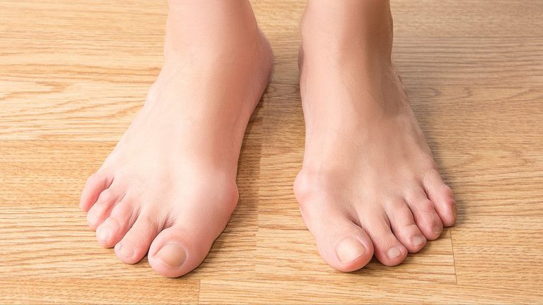 Does Rheumatoid Arthritis Affect Your Toes
