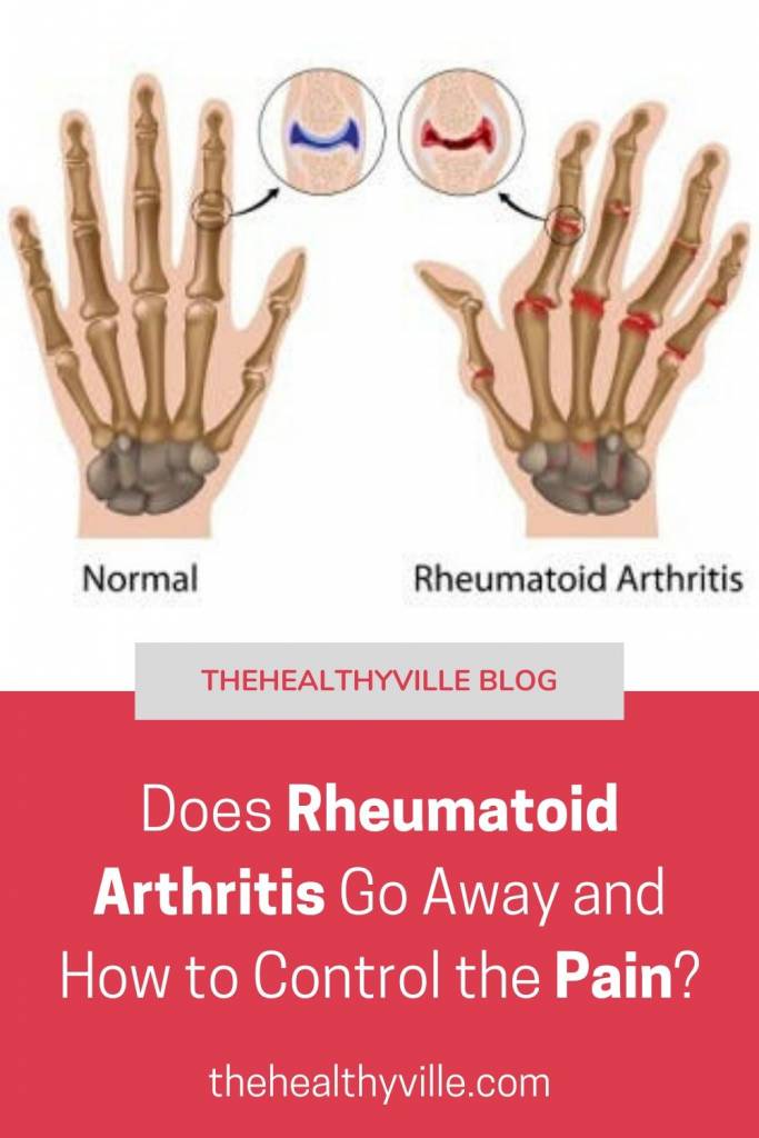 Does Rheumatoid Arthritis Go Away and How to Control the Pain?