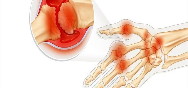 Does Rheumatoid Arthritis Go Away On Its Own