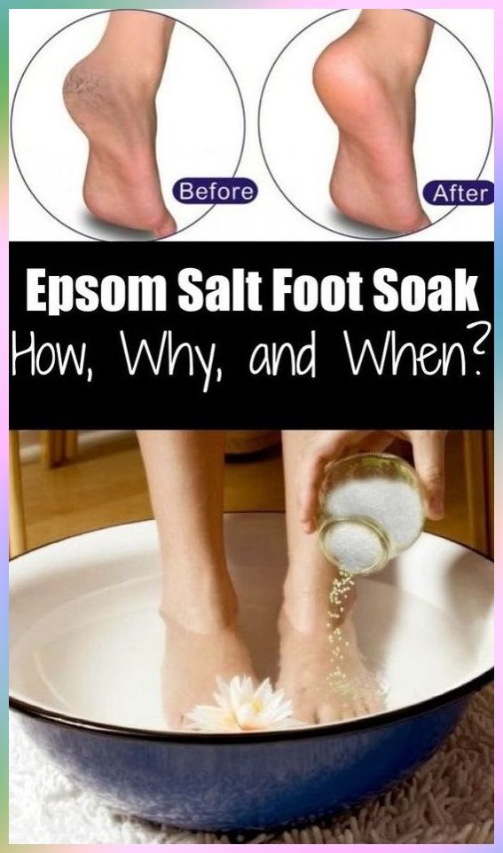 Does Soaking Your Feet In Epsom Salt Help Plantar ...
