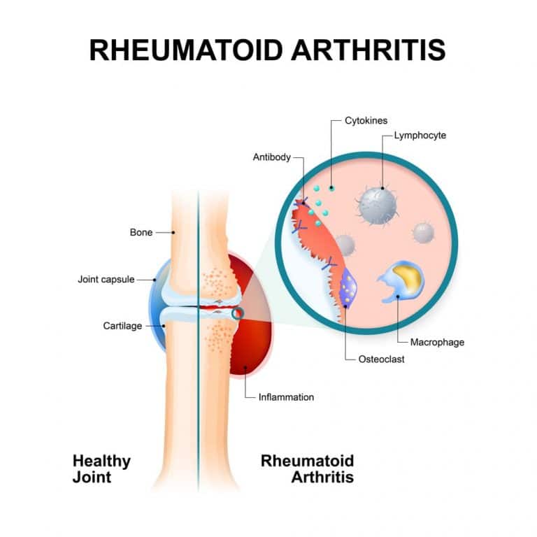 Drugs Used To Treat Rheumatoid Arthritis