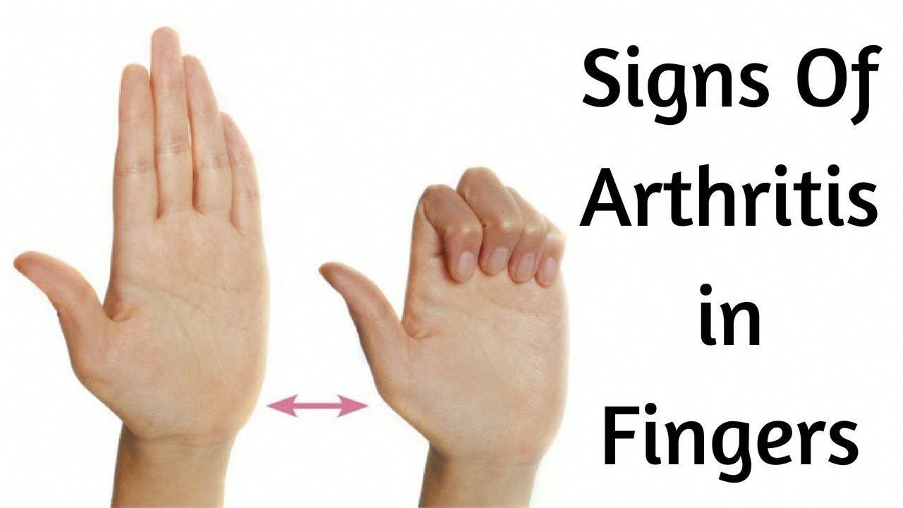 Early Signs of Arthritis in Fingers (should not be ignored) # ...