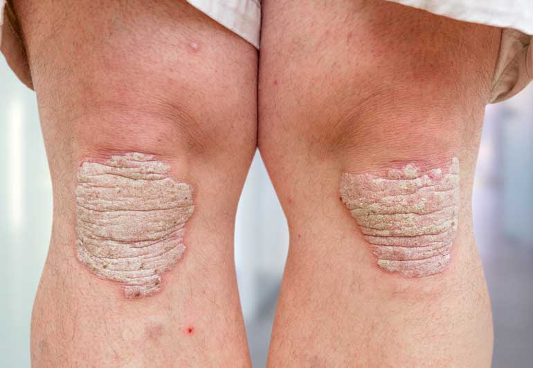 Early Signs of Psoriatic Arthritis â Cleveland Clinic